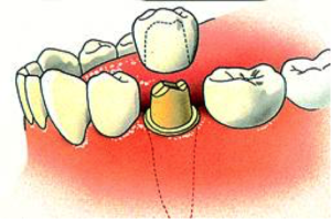 tandarts-Ijsselstein-kroon