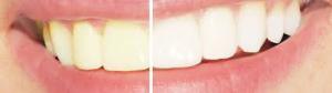 Tandartspraktijk-KiesenCo-IJsselstein-tanden-bleken